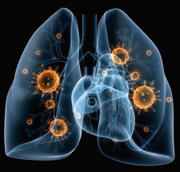 5-super-foods-you-must-have-during-pneumonia-for-a-speedy-recovery