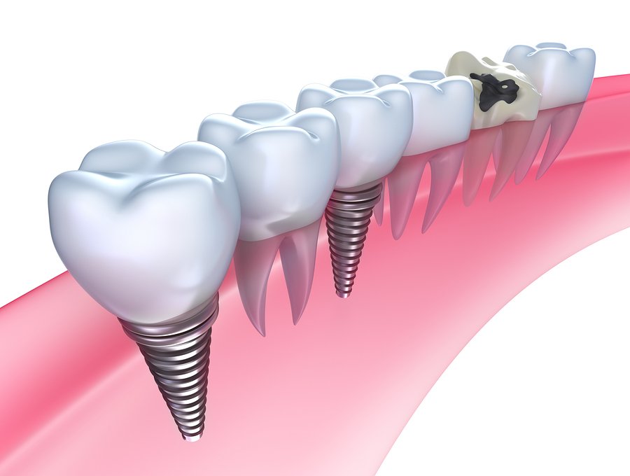 all-you-need-to-know-about-dental-implants
